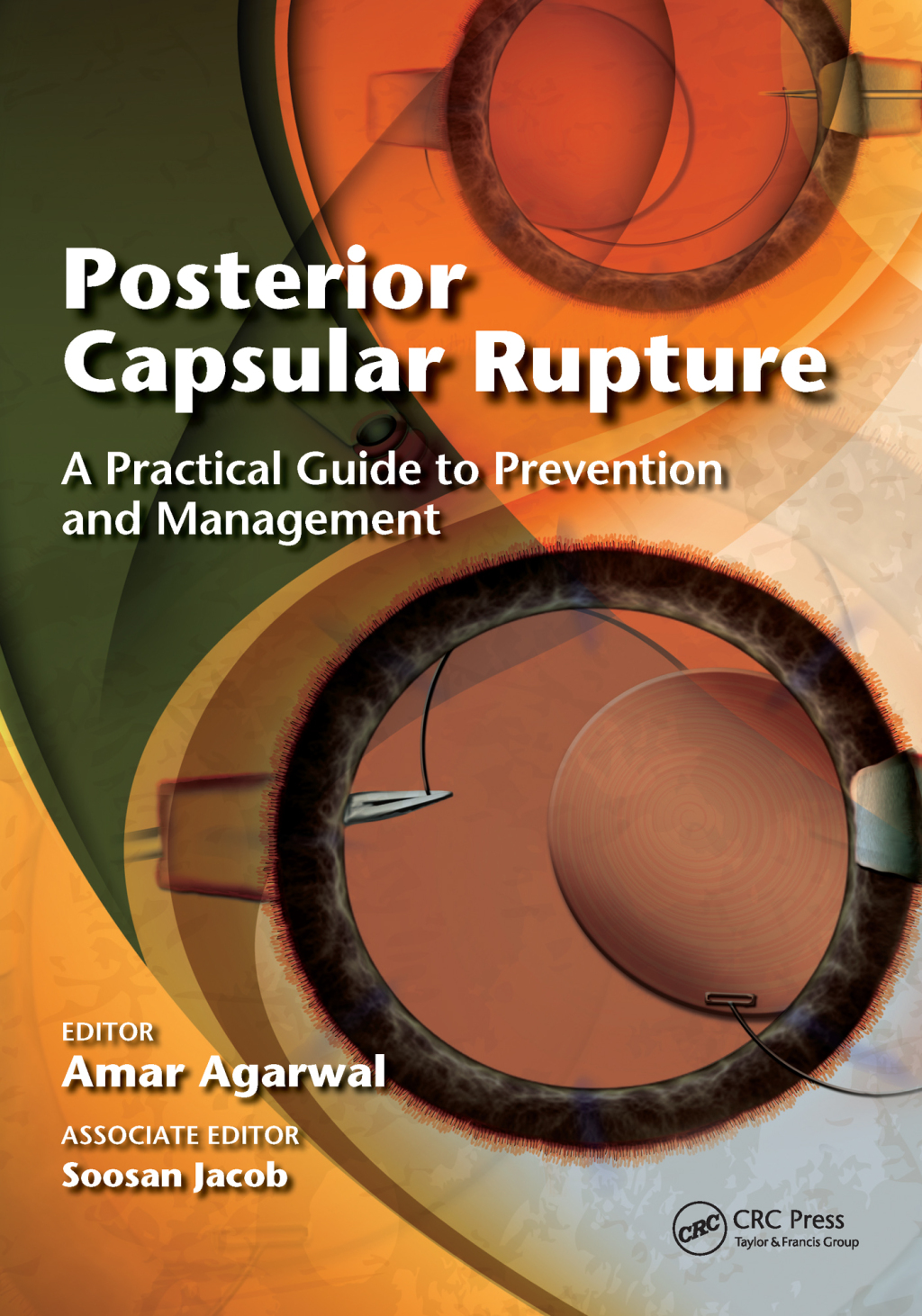 Posterior Capsular Rupture A Practical Guide to Prevention and Management 1st Edition â€“ PDF/EPUB Version Downloadable