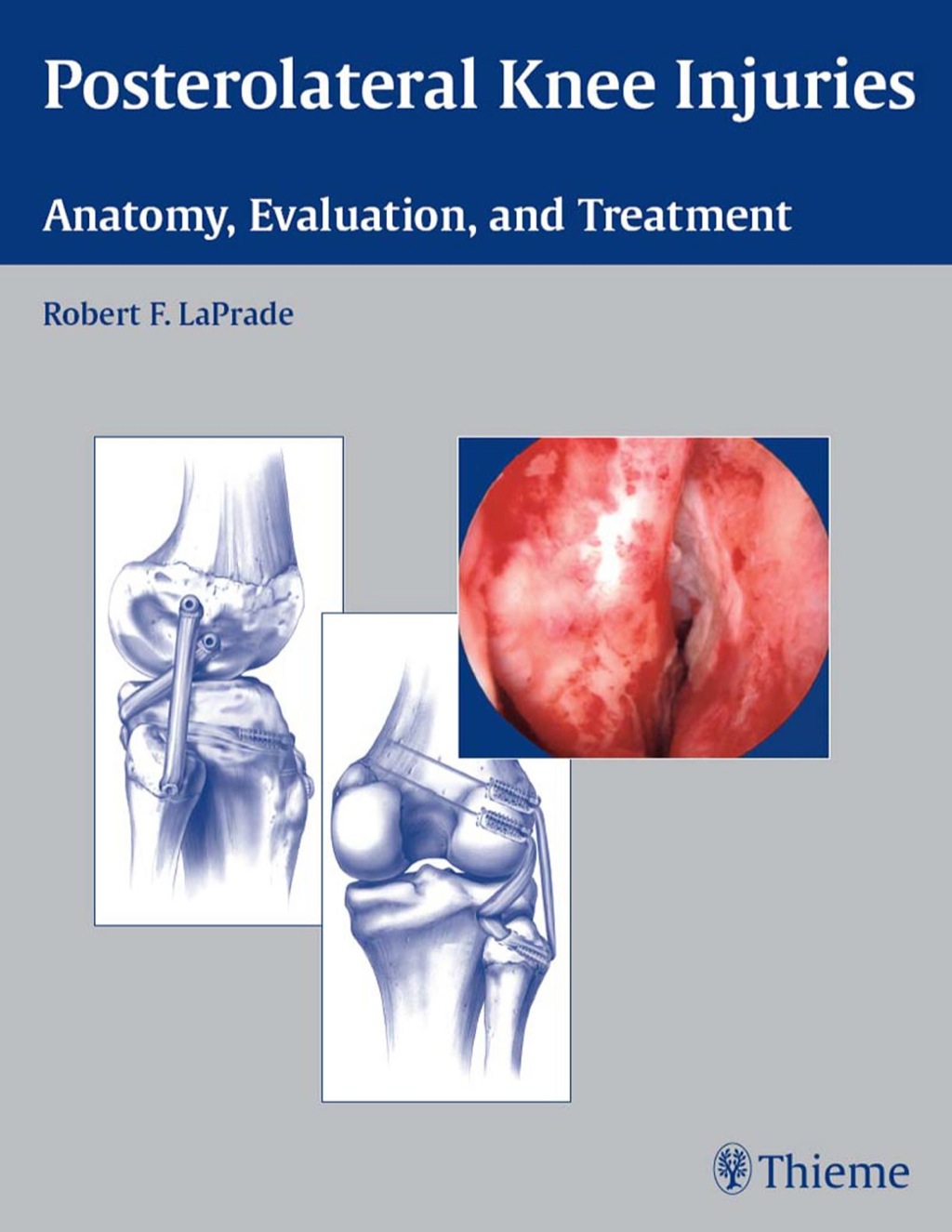 Posterolateral Knee Injuries Anatomy, Evaluation, and Treatment 1st Edition â€“ PDF/EPUB Version Downloadable