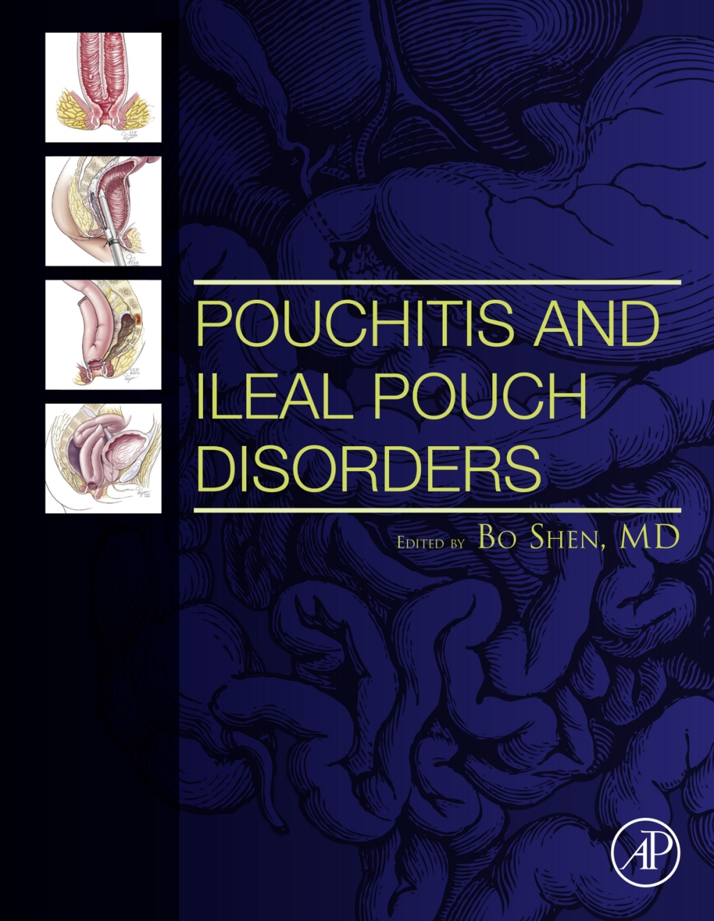 Pouchitis and Ileal Pouch Disorders A Multidisciplinary Approach for Diagnosis and Management  â€“ PDF/EPUB Version Downloadable
