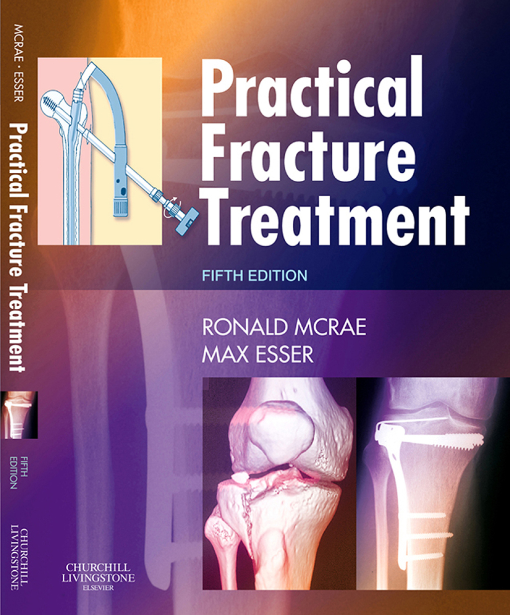 Practical Fracture Treatment 5th Edition â€“ PDF/EPUB Version Downloadable