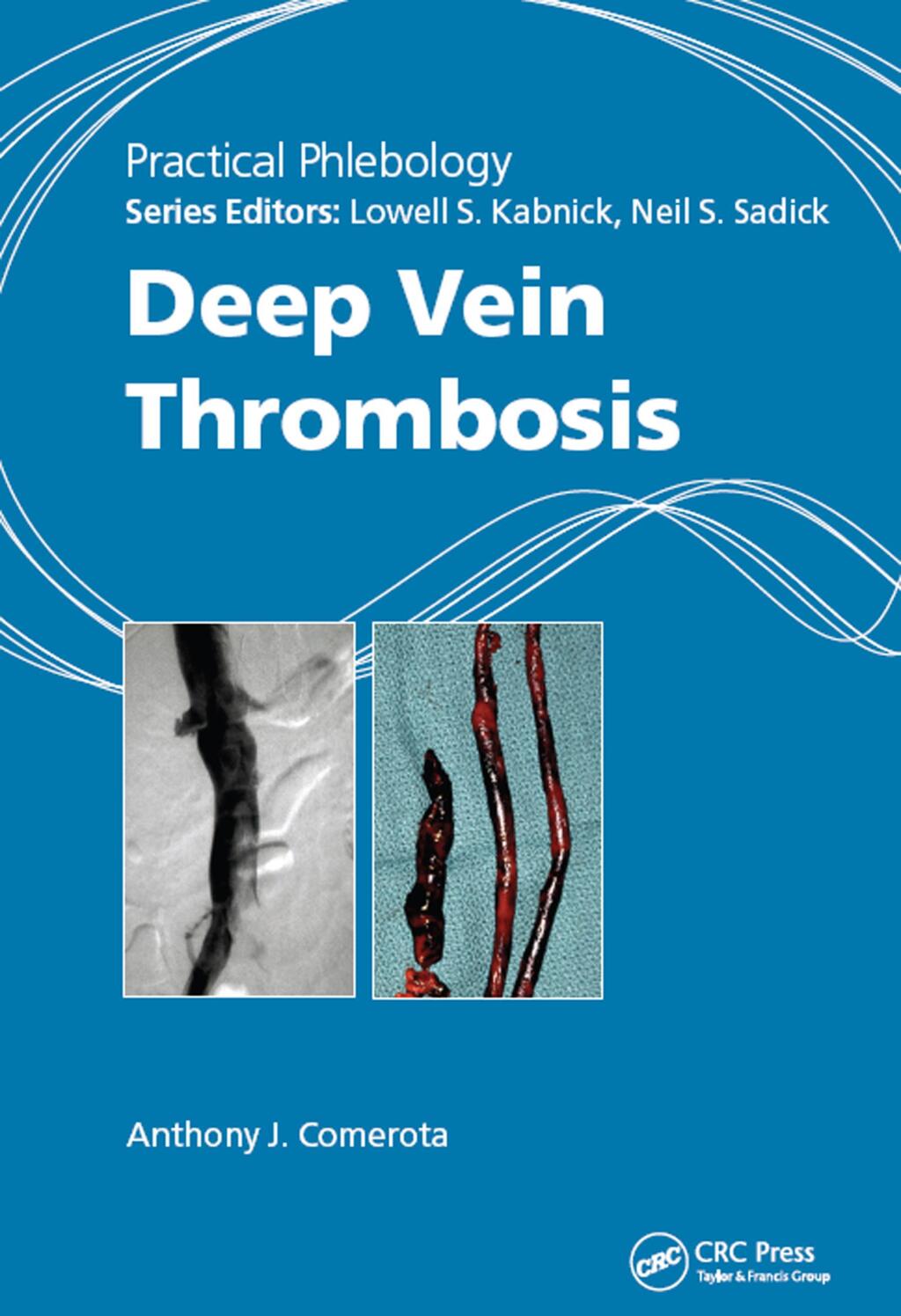 Practical Phlebology Deep Vein Thrombosis 1st Edition â€“ PDF/EPUB Version Downloadable