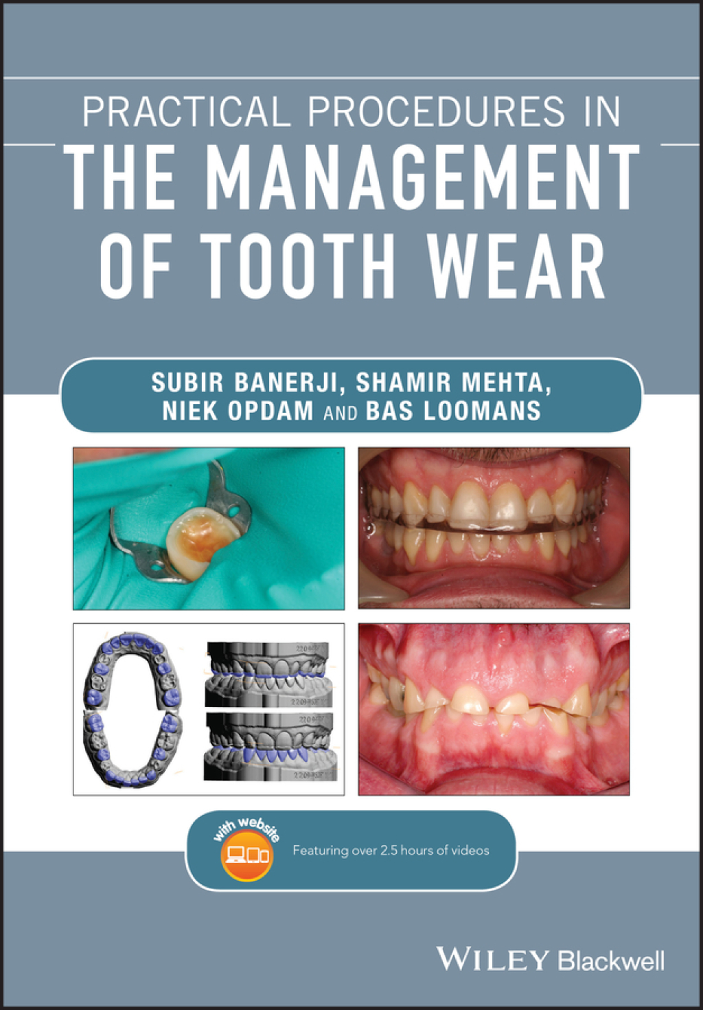 Practical Procedures in the Management of Tooth Wear 1st Edition â€“ PDF/EPUB Version Downloadable