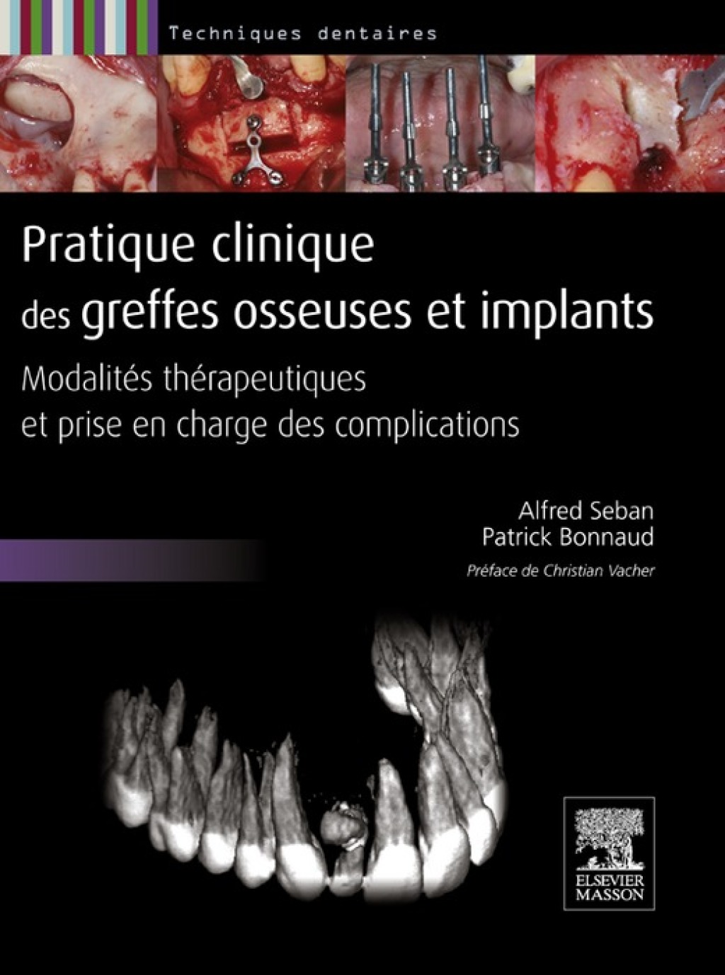 Pratique clinique des greffes osseuses et implants ModalitÃ©s thÃ©rapeutiques et prise en charge des complications  â€“ PDF/EPUB Version Downloadable