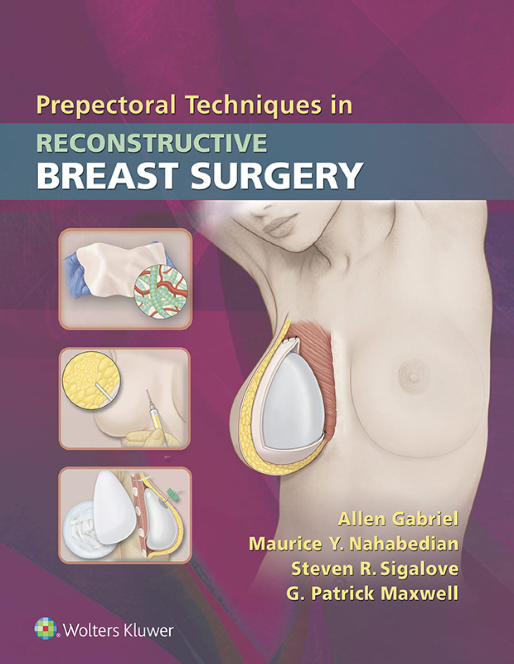 Prepectoral Techniques in Reconstructive Breast Surgery  â€“ PDF/EPUB Version Downloadable