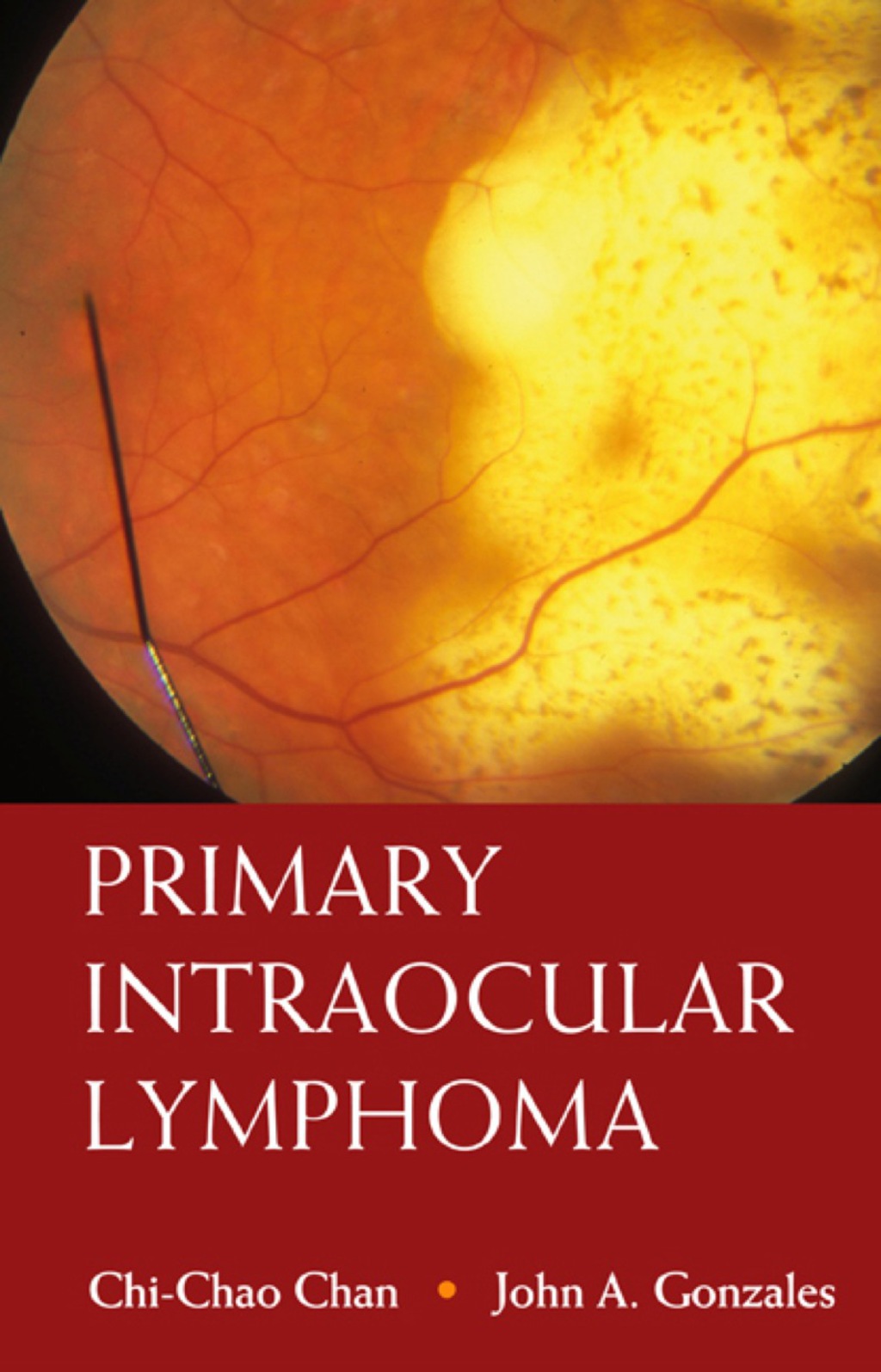 Primary Intraocular Lymphoma  â€“ PDF/EPUB Version Downloadable