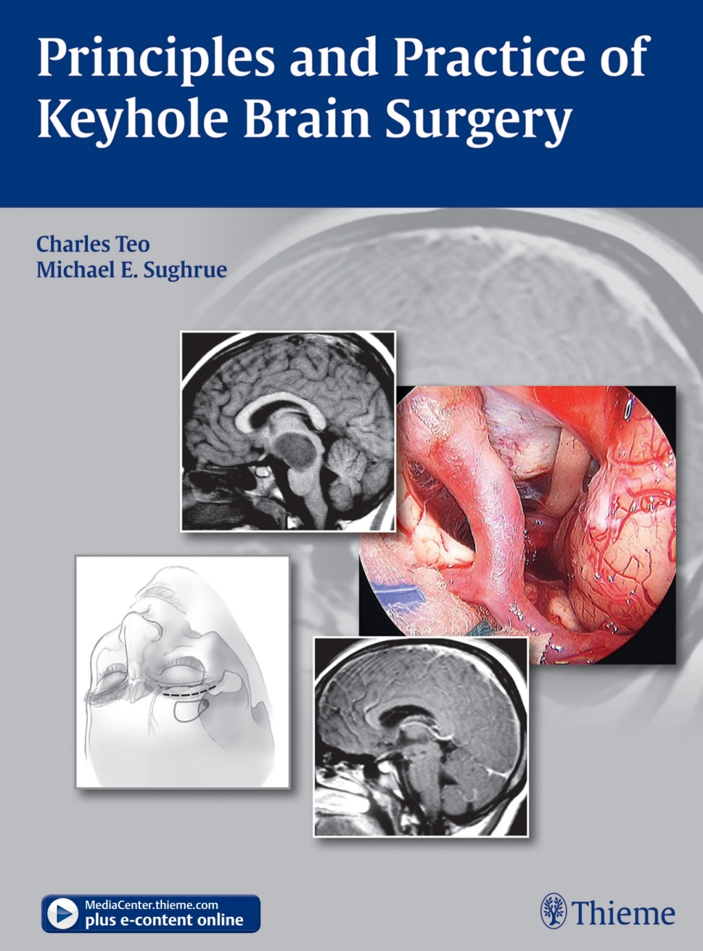 Principles and Practice of Keyhole Brain Surgery 1st Edition â€“ PDF/EPUB Version Downloadable