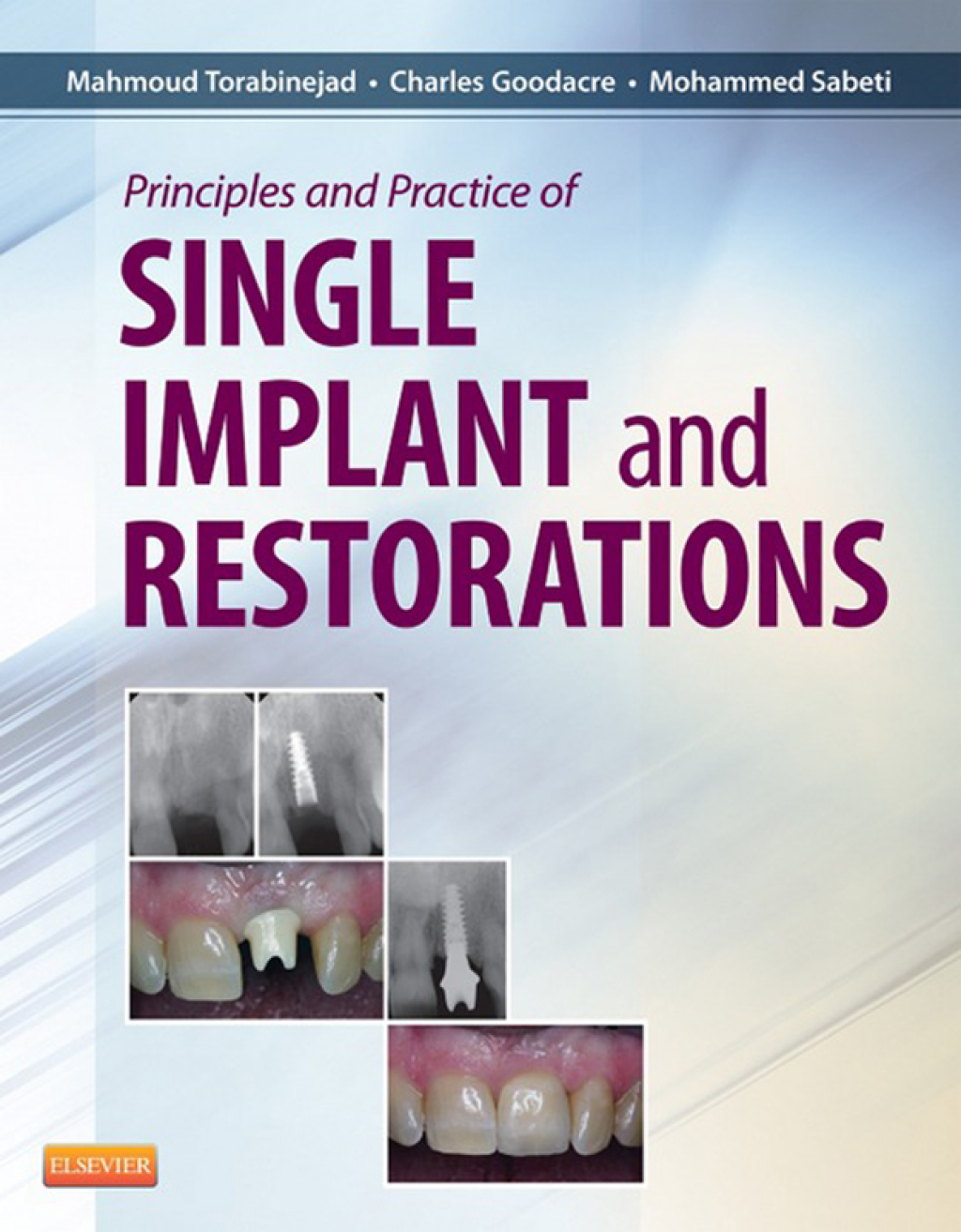 Principles and Practice of Single Implant and Restoration  â€“ PDF/EPUB Version Downloadable