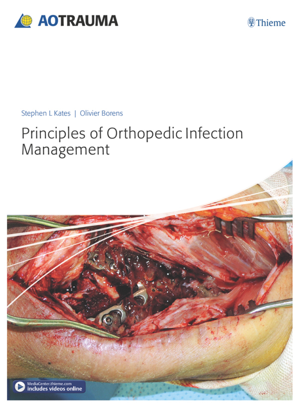Principles of Orthopedic Infection Management 1st Edition â€“ PDF/EPUB Version Downloadable