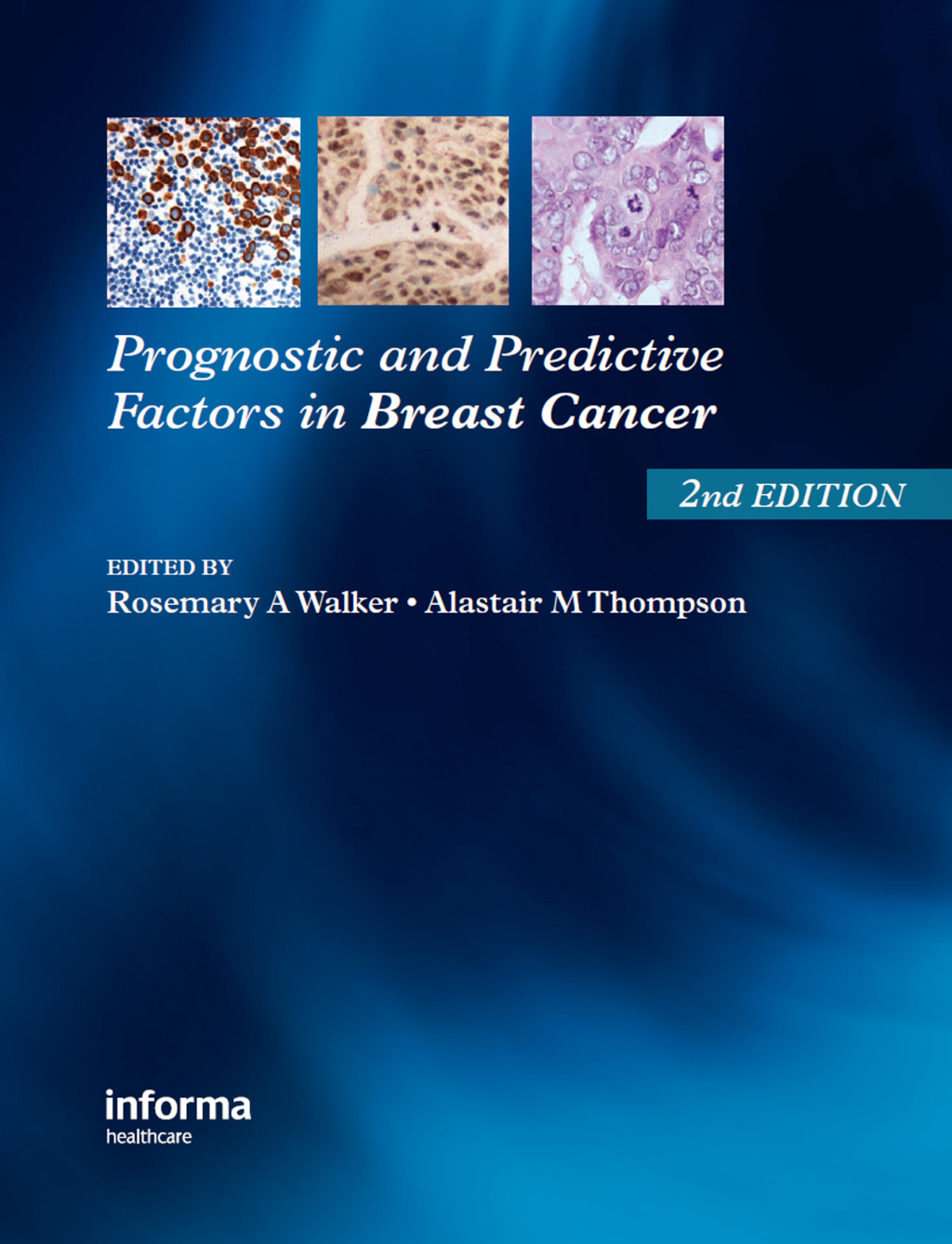 Prognostic and Predictive Factors in Breast Cancer 2nd Edition â€“ PDF/EPUB Version Downloadable