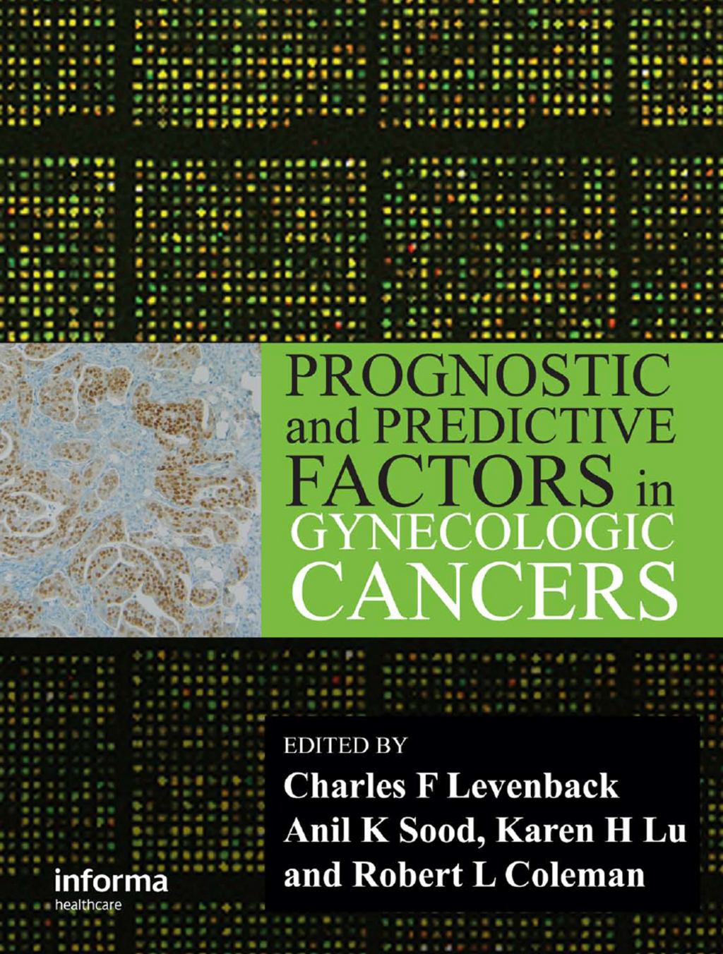 Prognostic and Predictive Factors in Gynecologic Cancers 1st Edition â€“ PDF/EPUB Version Downloadable