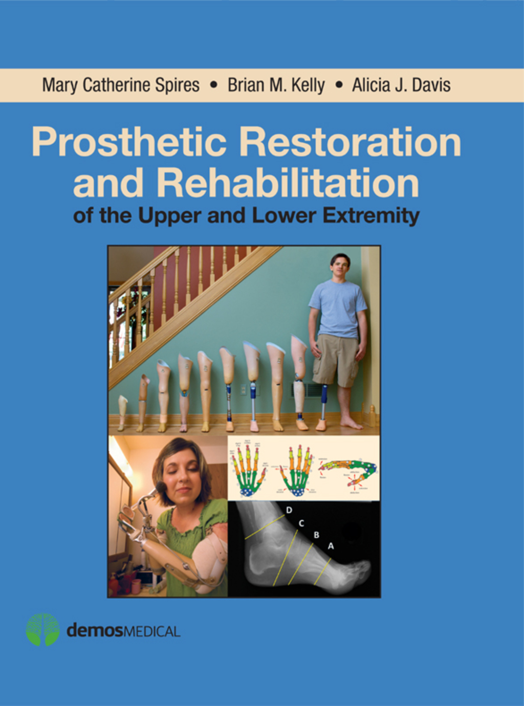 Prosthetic Restoration and Rehabilitation of the Upper and Lower Extremity 1st Edition â€“ PDF/EPUB Version Downloadable