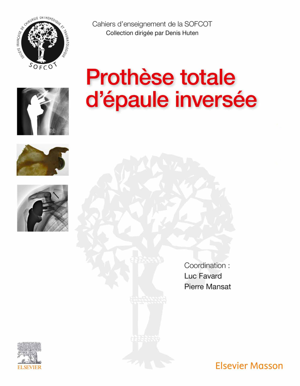 ProthÃ¨se totale d'Ã©paule inversÃ©e  â€“ PDF/EPUB Version Downloadable