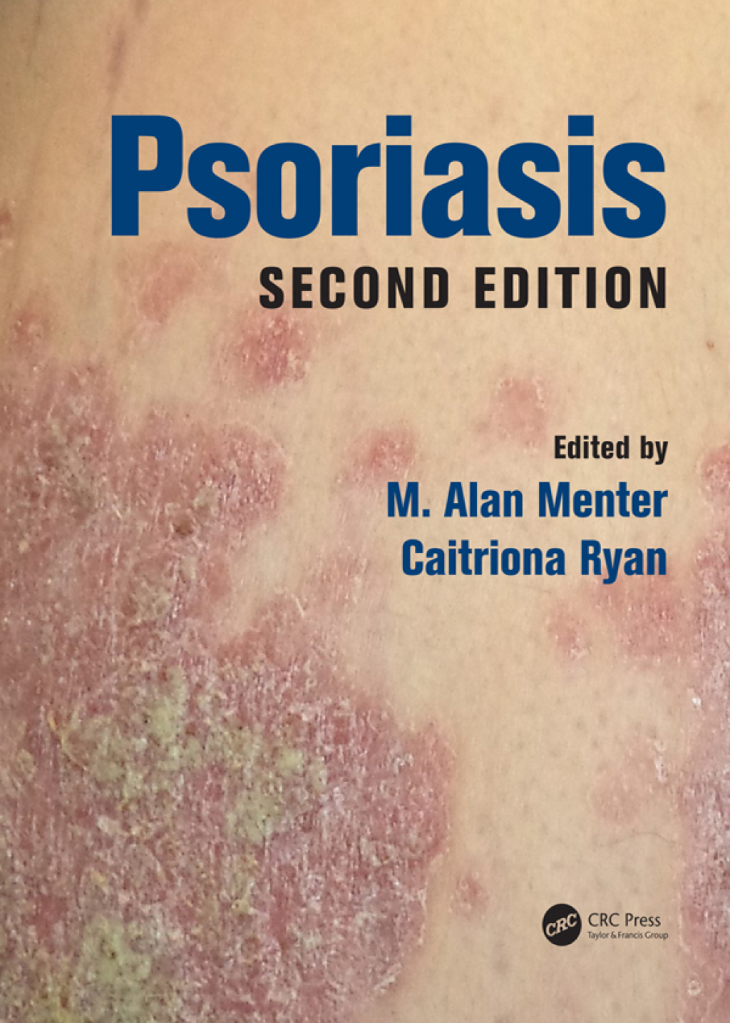 Psoriasis 2nd Edition â€“ PDF/EPUB Version Downloadable