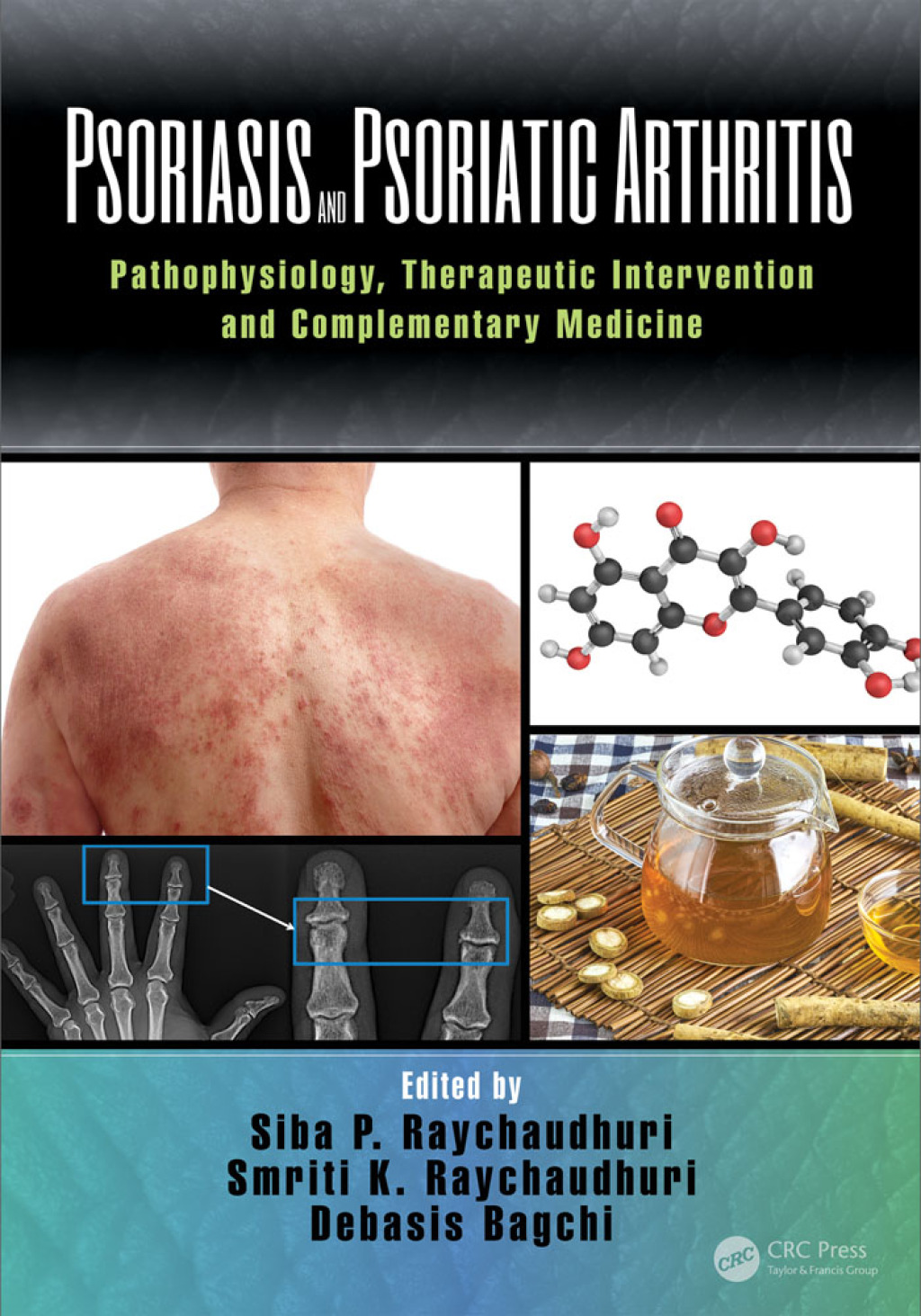 Psoriasis and Psoriatic Arthritis Pathophysiology, Therapeutic Intervention, and Complementary Medicine 1st Edition â€“ PDF/EPUB Version Downloadable