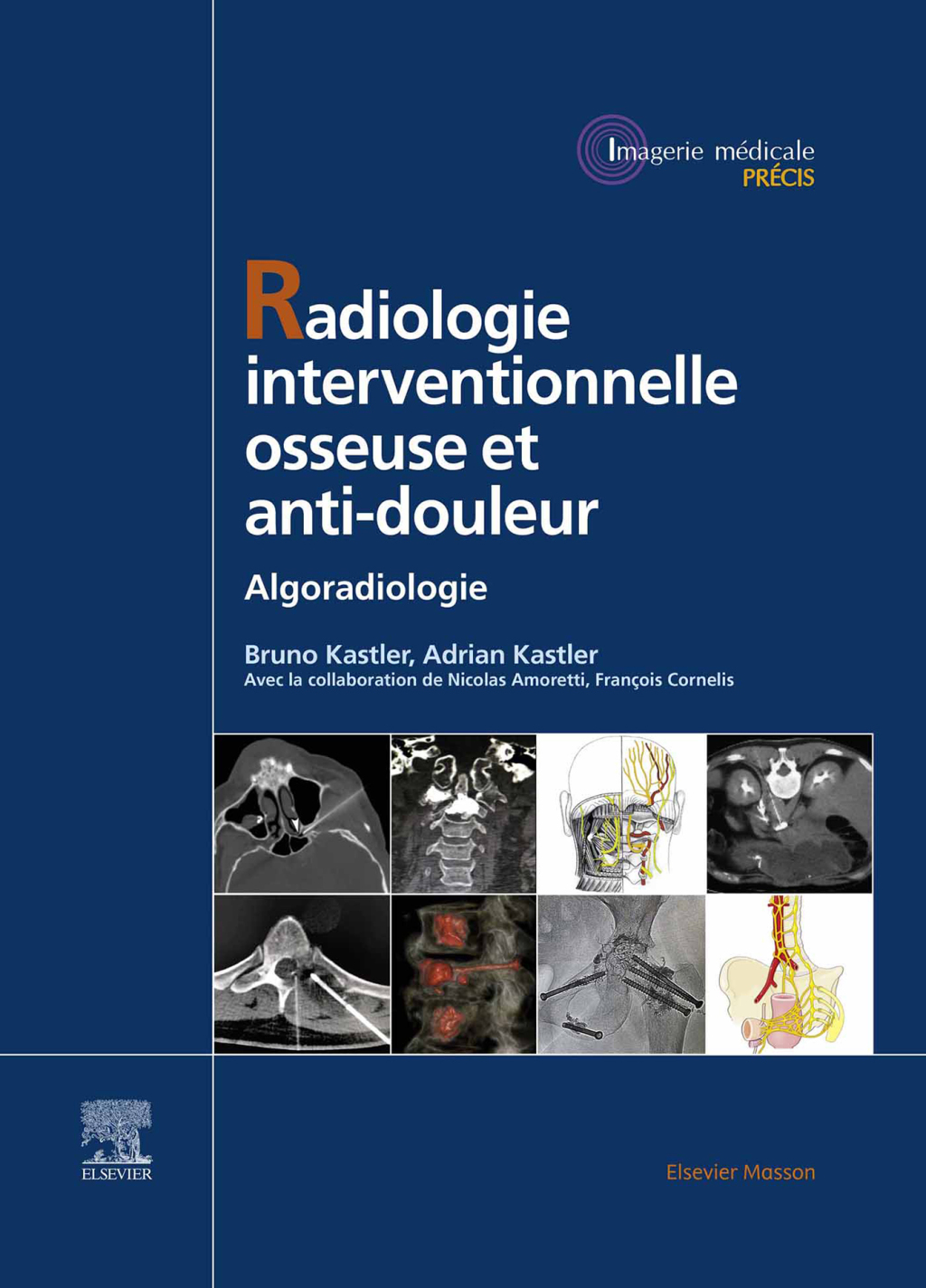 Radiologie Interventionnelle osseuse et anti-douleur Algoradiologie  â€“ PDF/EPUB Version Downloadable