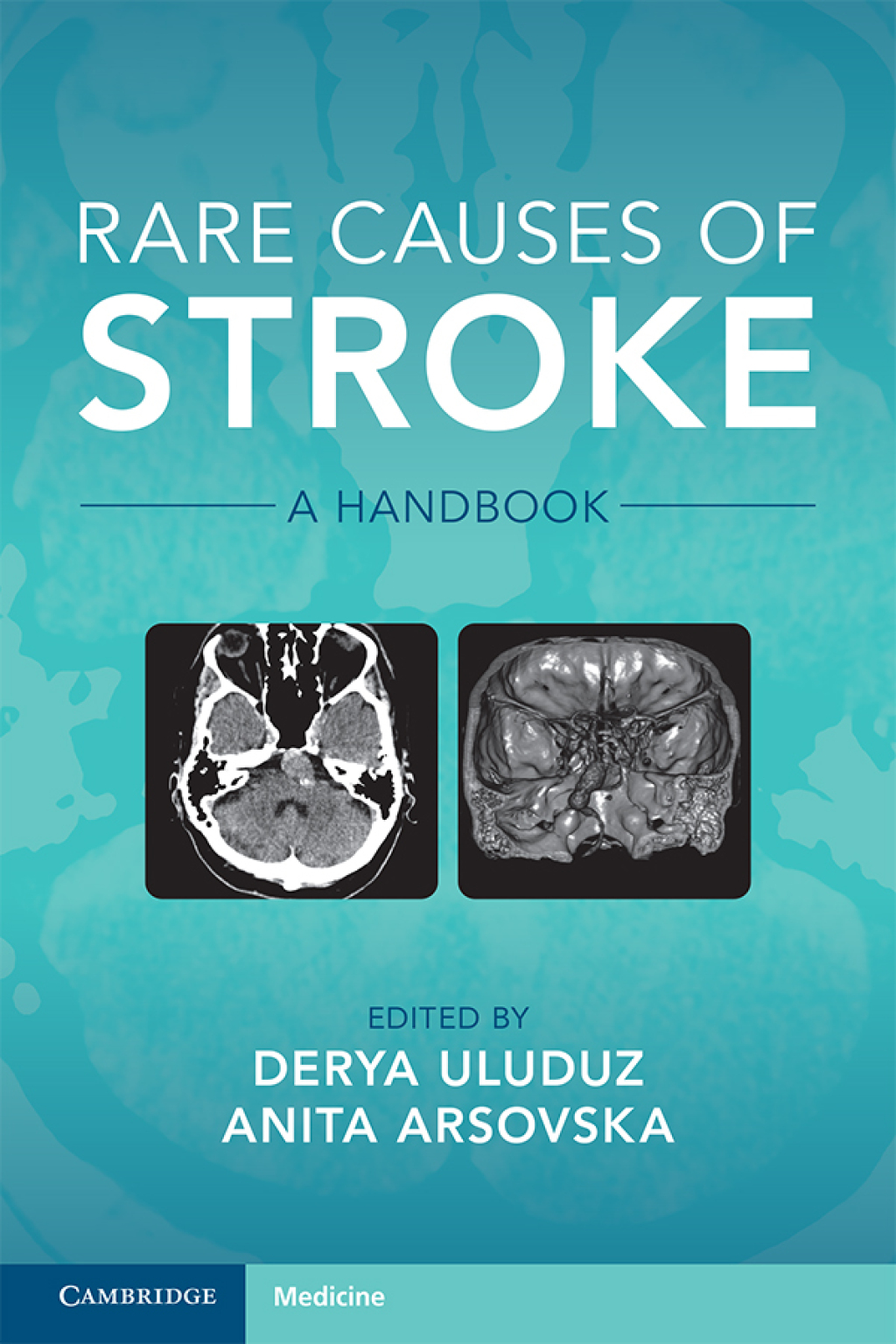 Rare Causes of Stroke A Handbook  â€“ PDF/EPUB Version Downloadable