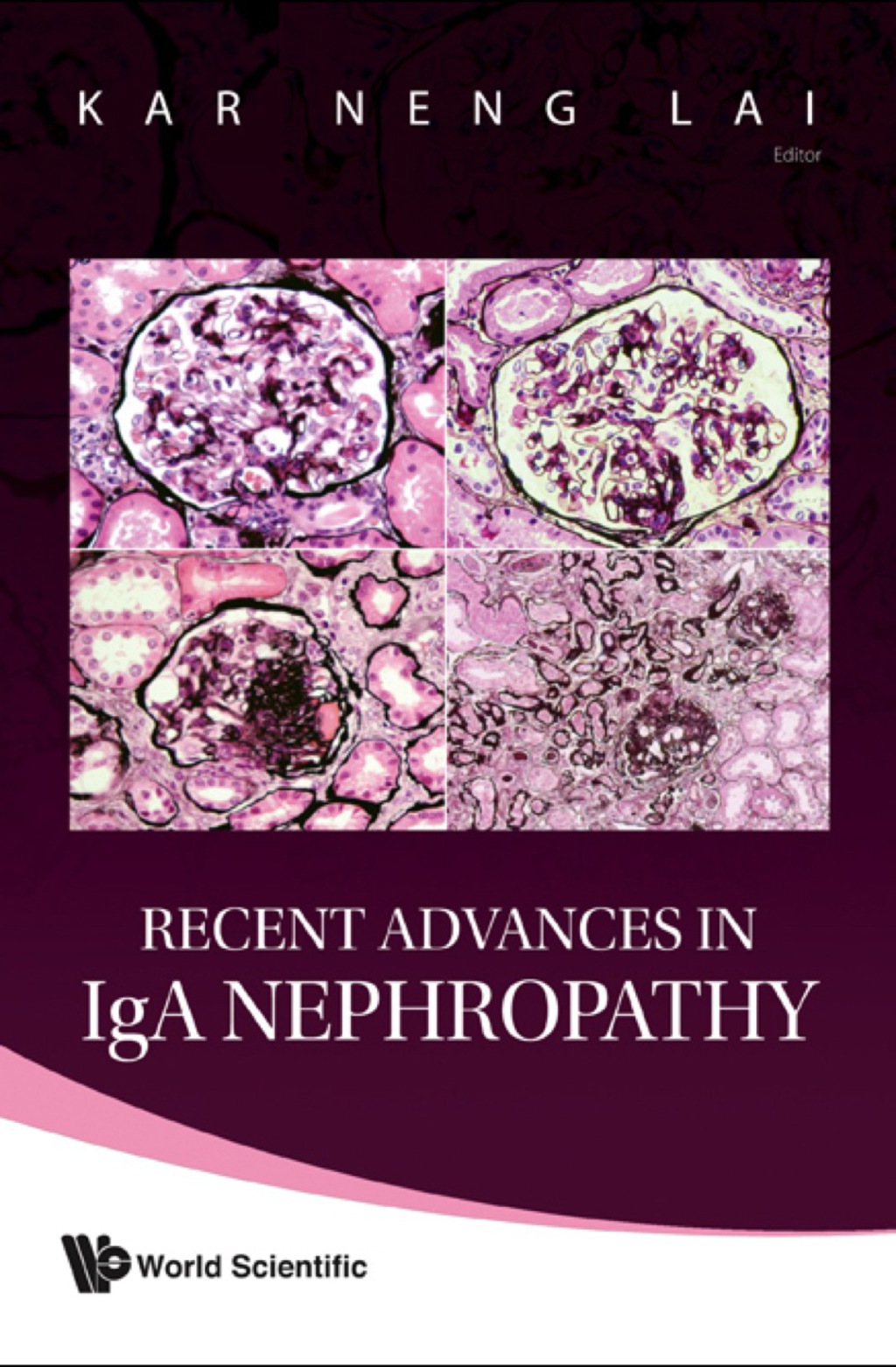 RECENT ADVANCES IN IGA NEPHROPATHY  â€“ PDF/EPUB Version Downloadable