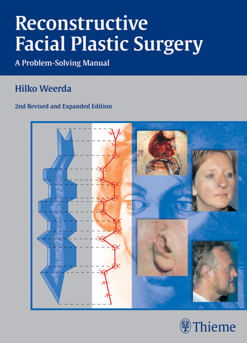 Reconstructive Facial Plastic Surgery A Problem-Solving Manual 2nd ...