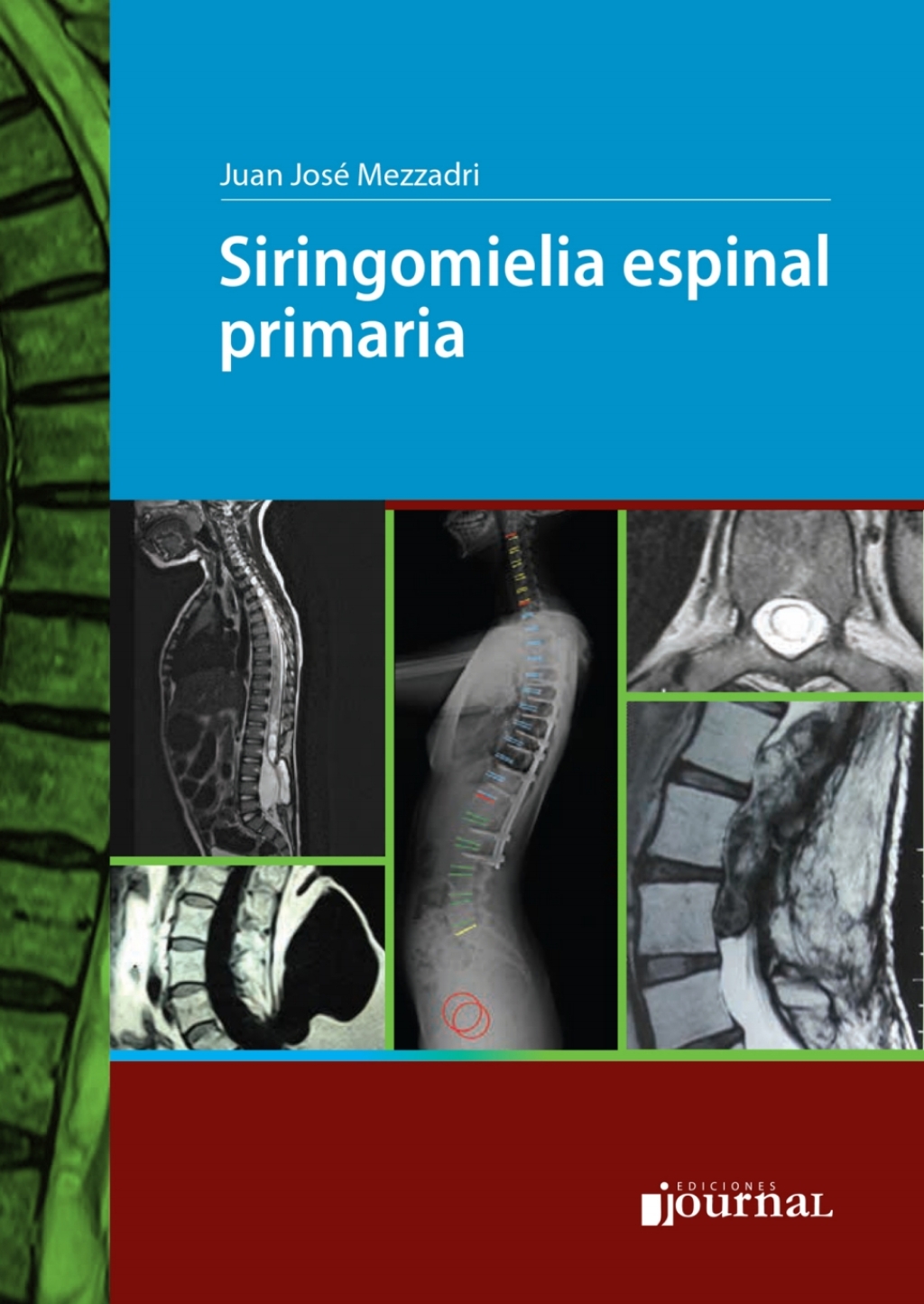 Siringomielia espinal primaria 1st Edition â€“ PDF/EPUB Version Downloadable