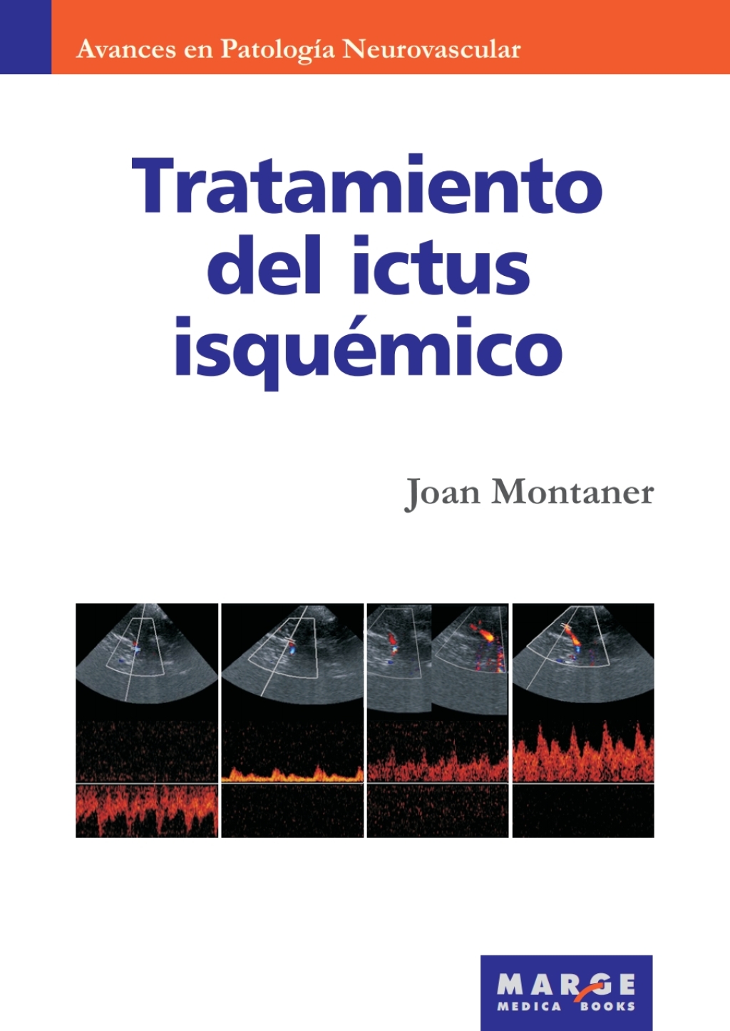 Tratamiento del ictus isquÃ©mico 1st Edition - (PDF/EPUB Version)