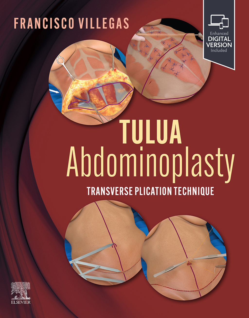 TULUA Abdominoplasty Transverse Plication Technique â€“ PDF/EPUB ...