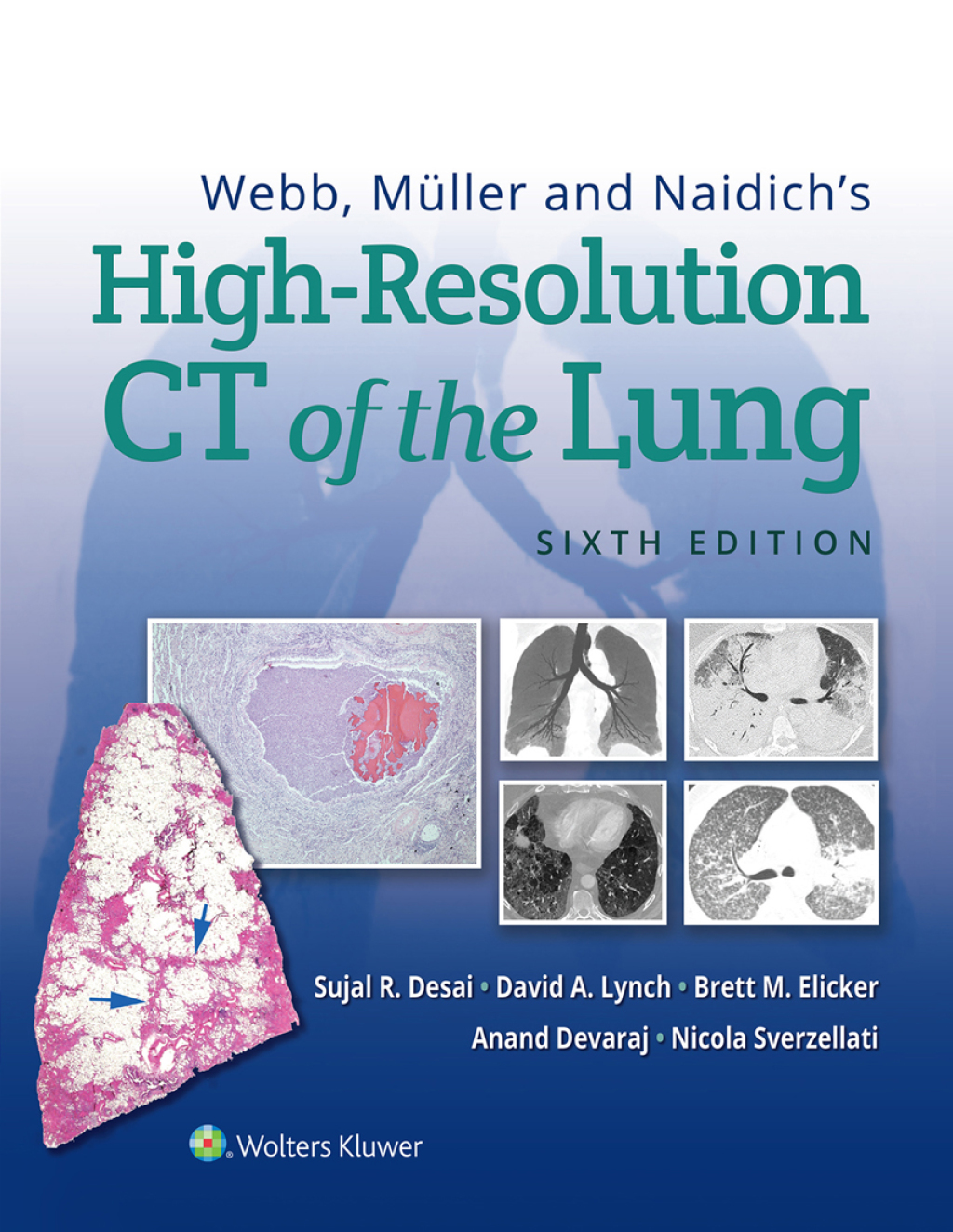 Webb, MÃ¼ller and Naidich's High-Resolution CT of the Lung 6th Edition â€“ PDF/EPUB Version Downloadable